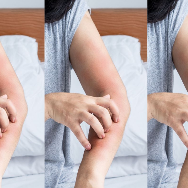Perimenopause and Itchy Skin: 5 Expert Strategies for Relief!