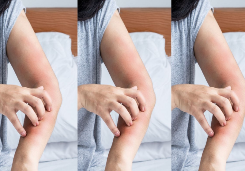 woman with perimenopause and skin itching