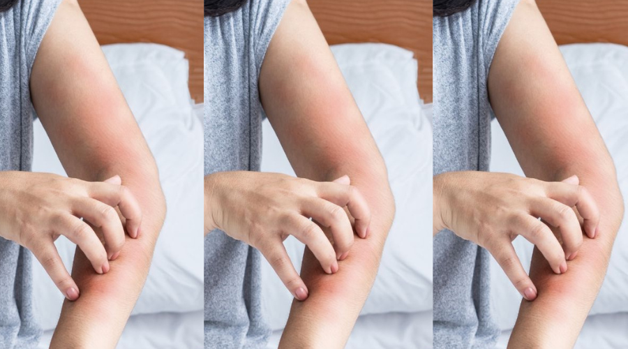 woman with perimenopause and skin itching