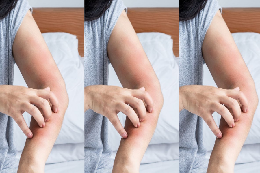 woman with perimenopause and skin itching